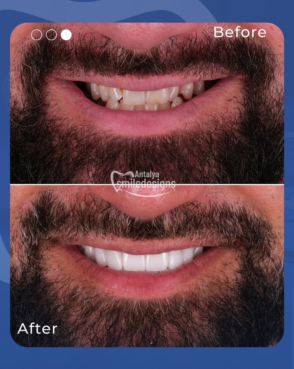 Before and after veneers result at Antalya Smile Designs – improved smile aesthetics for men