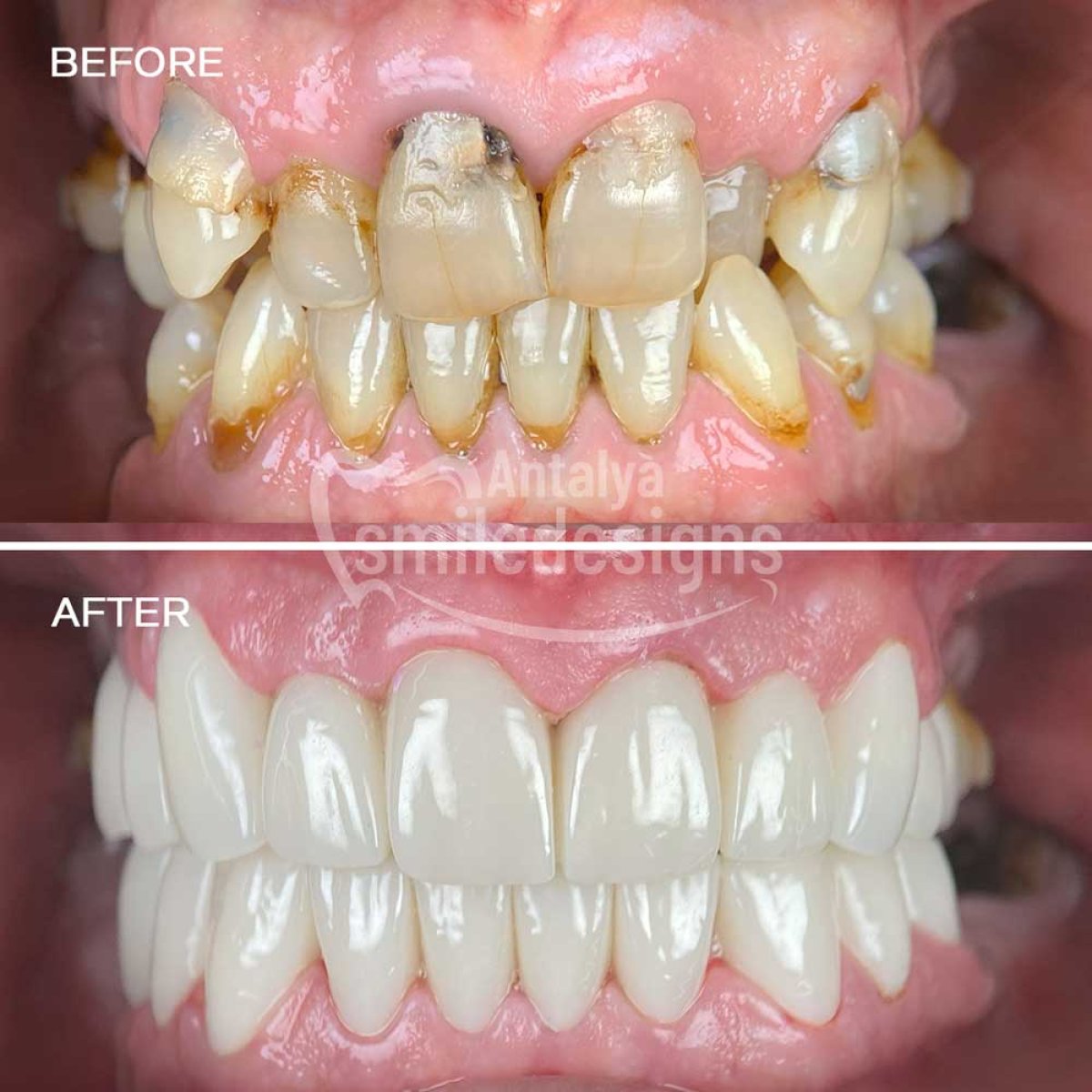 Before and after dental bonding results at Antalya Smile Designs, improved smile aesthetics