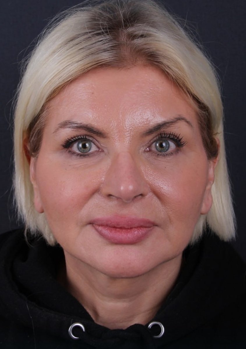 Facelift result at Ali Cetinkaya M.D. clinic – rejuvenated facial appearance after procedure