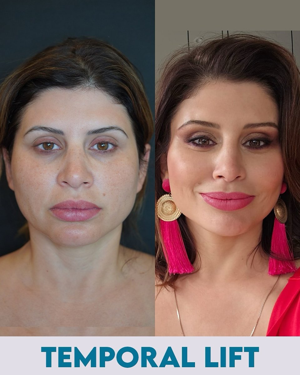 Before and after temporal lift results at Ali Cetinkaya M.D., visible facial rejuvenation
