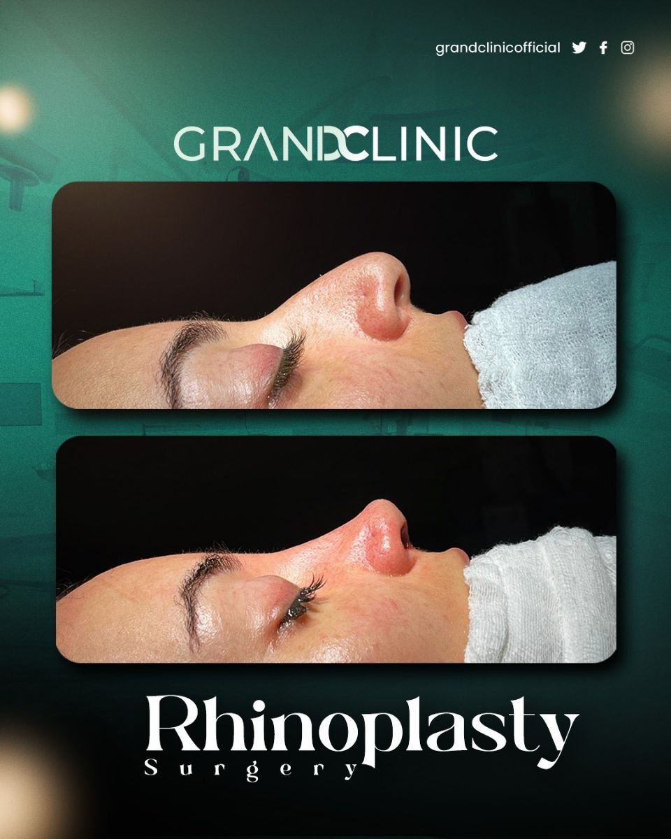 Результаты ринопластики до и после в Grand Clinic, видимое улучшение формы носа