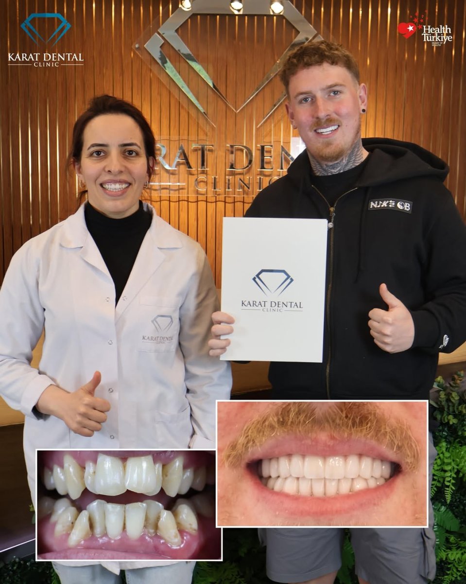Результаты до и после установки циркониевых коронок в Karat Dental Clinic – новая улыбка
