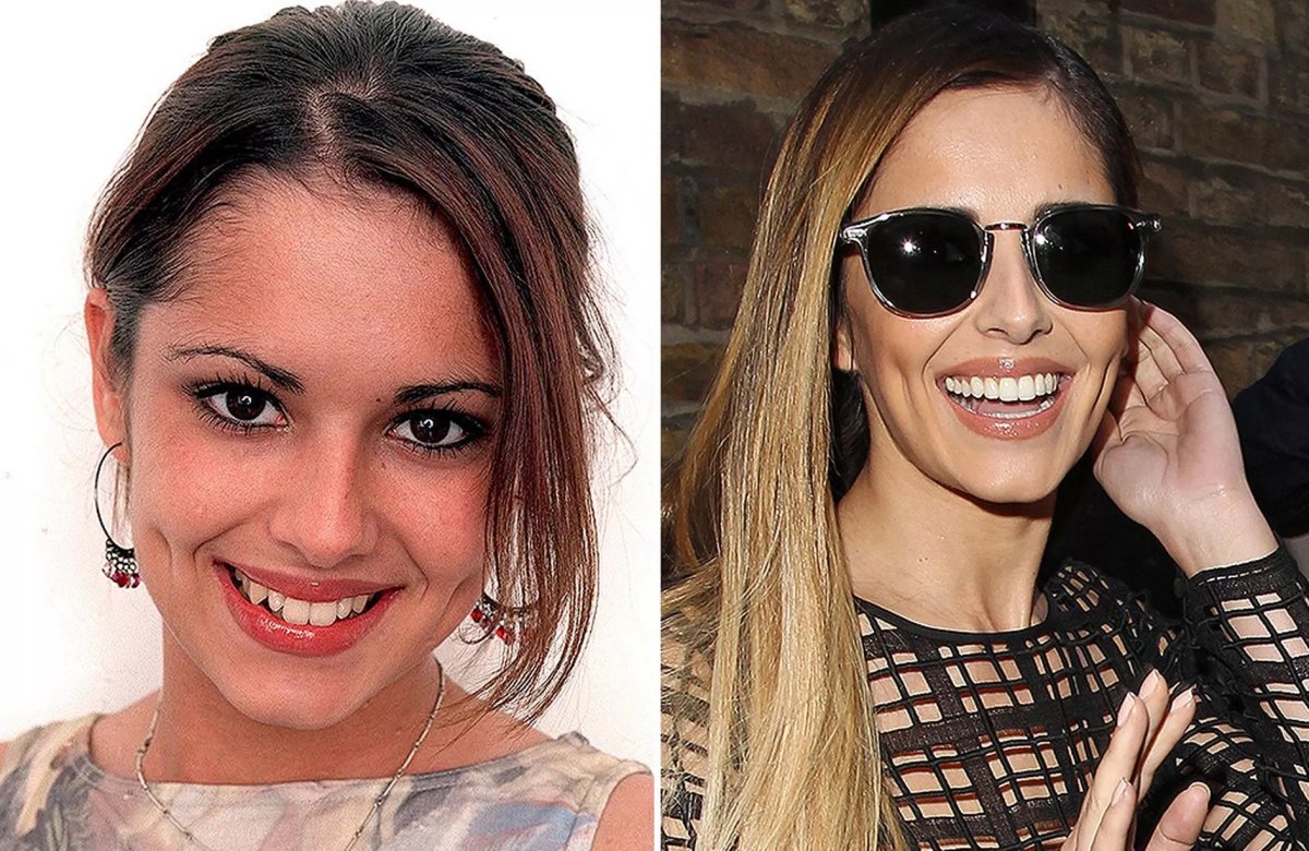 Результаты до и после Hollywood Smile в Karat Dental Clinic – заметное преображение улыбки
