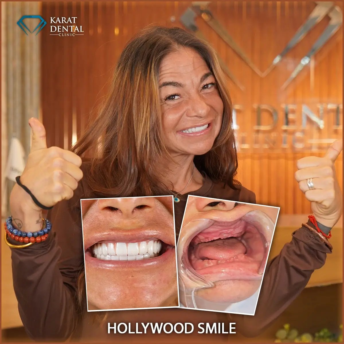 نتائج ابتسامة هوليوود في Karat Dental Clinic – قبل وبعد تركيب القشور الخزفية