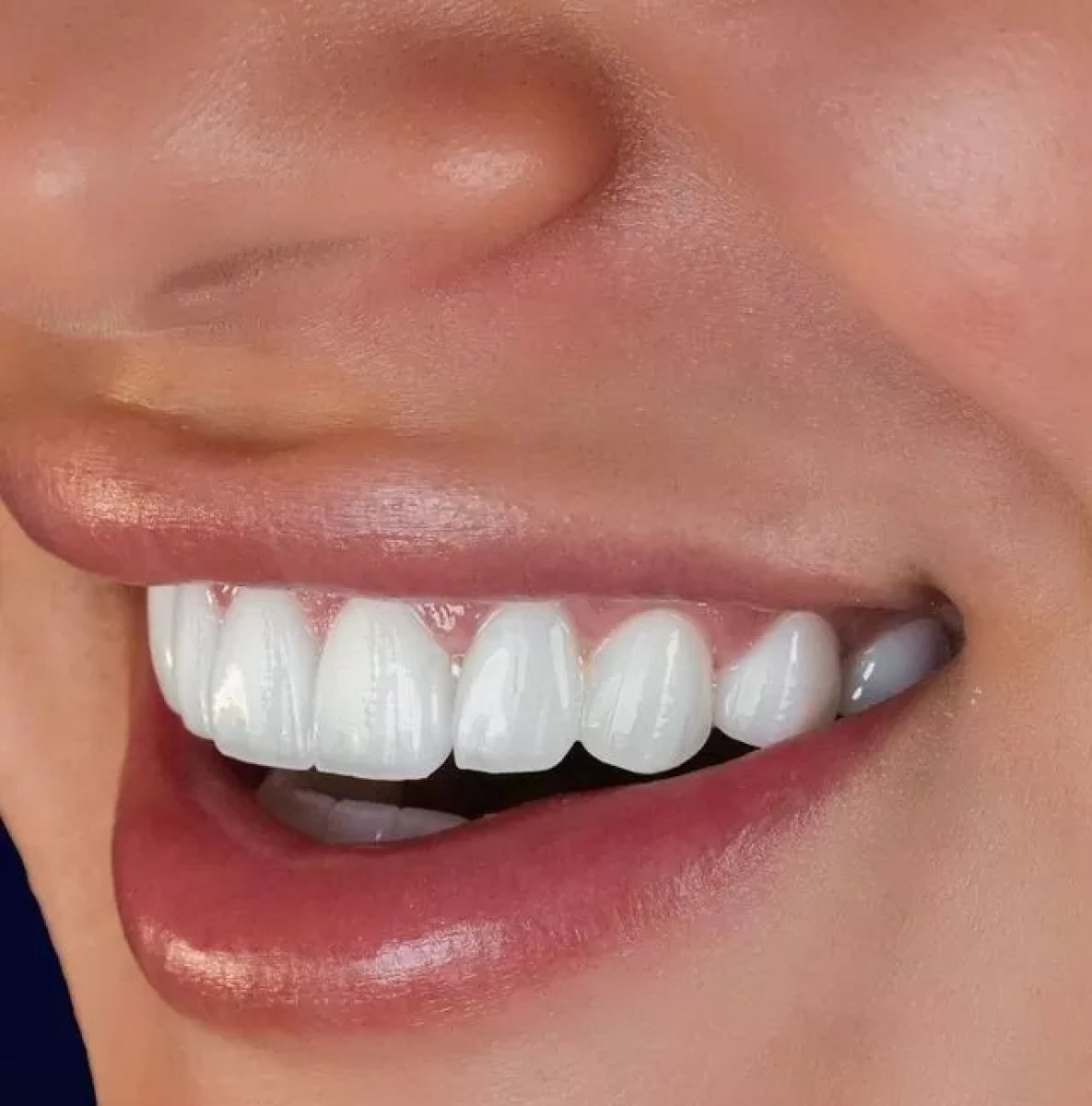 Результат установки циркониевых коронок в Astra Dental Clinic – белоснежная улыбка