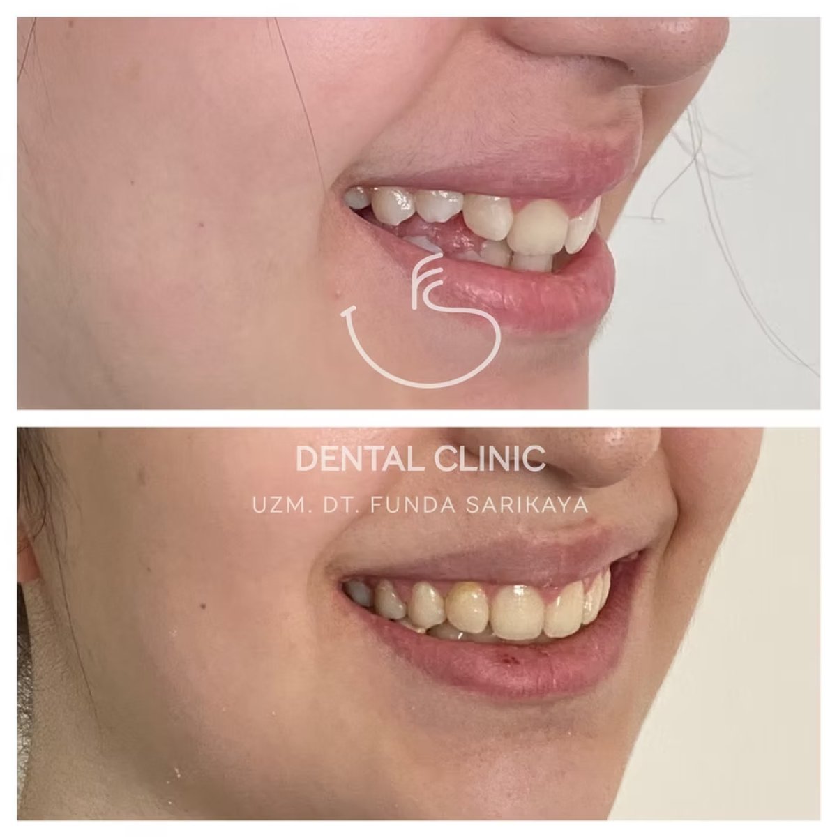 نتائج قبل وبعد تقويم Invisalign في عيادة Funda Sarıkaya، تحسين انتظام الأسنان