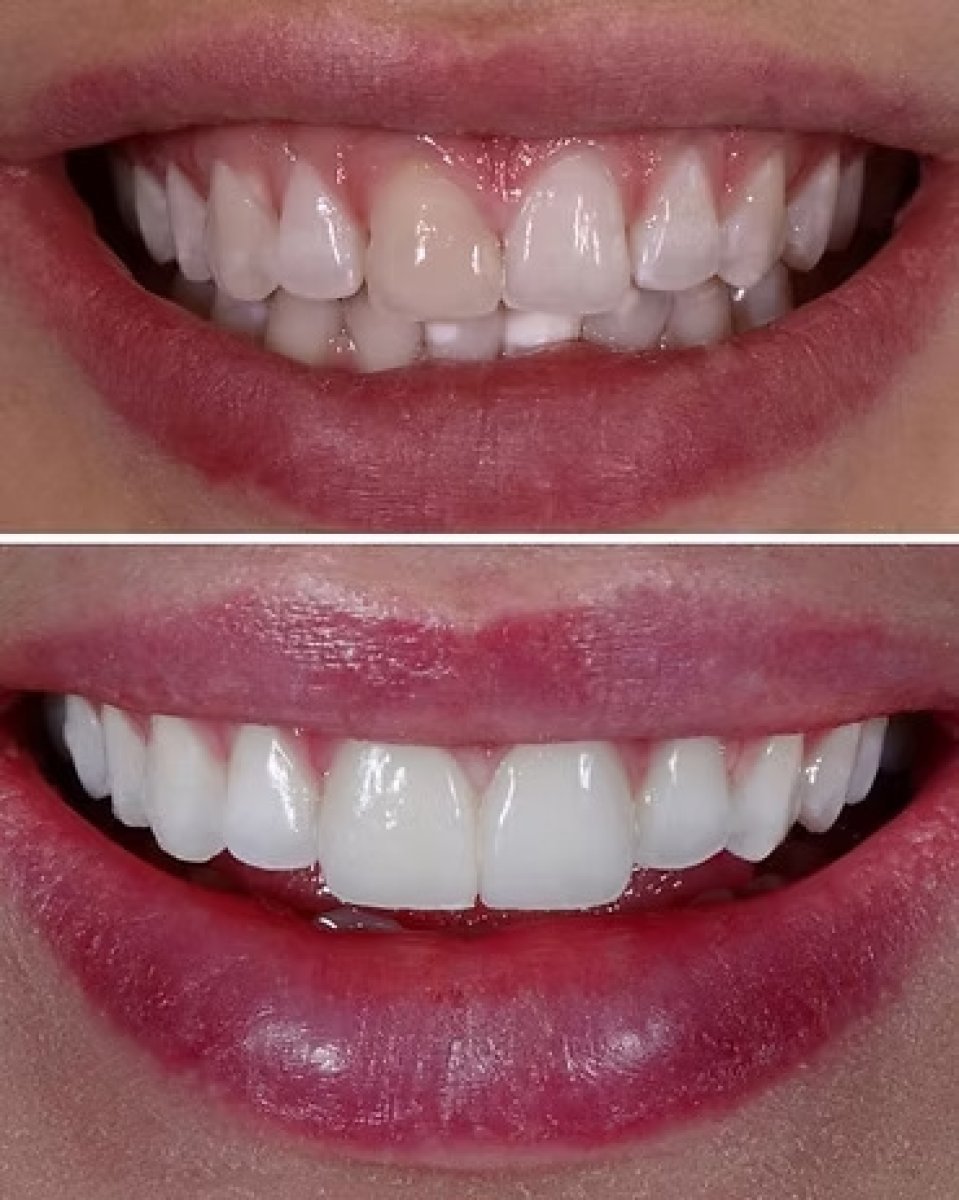Before and after veneers result at Funda Sarıkaya Diş Polikliniği - Dental Clinic Ankara