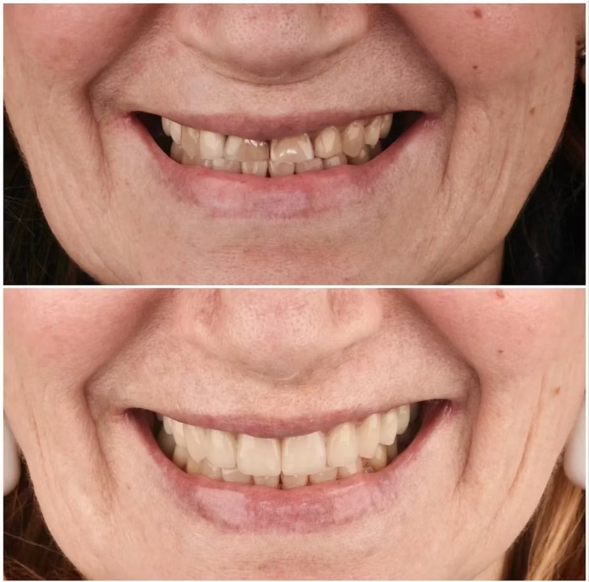 Before and after veneers result at Funda Sarıkaya Diş Polikliniği - improved smile aesthetics
