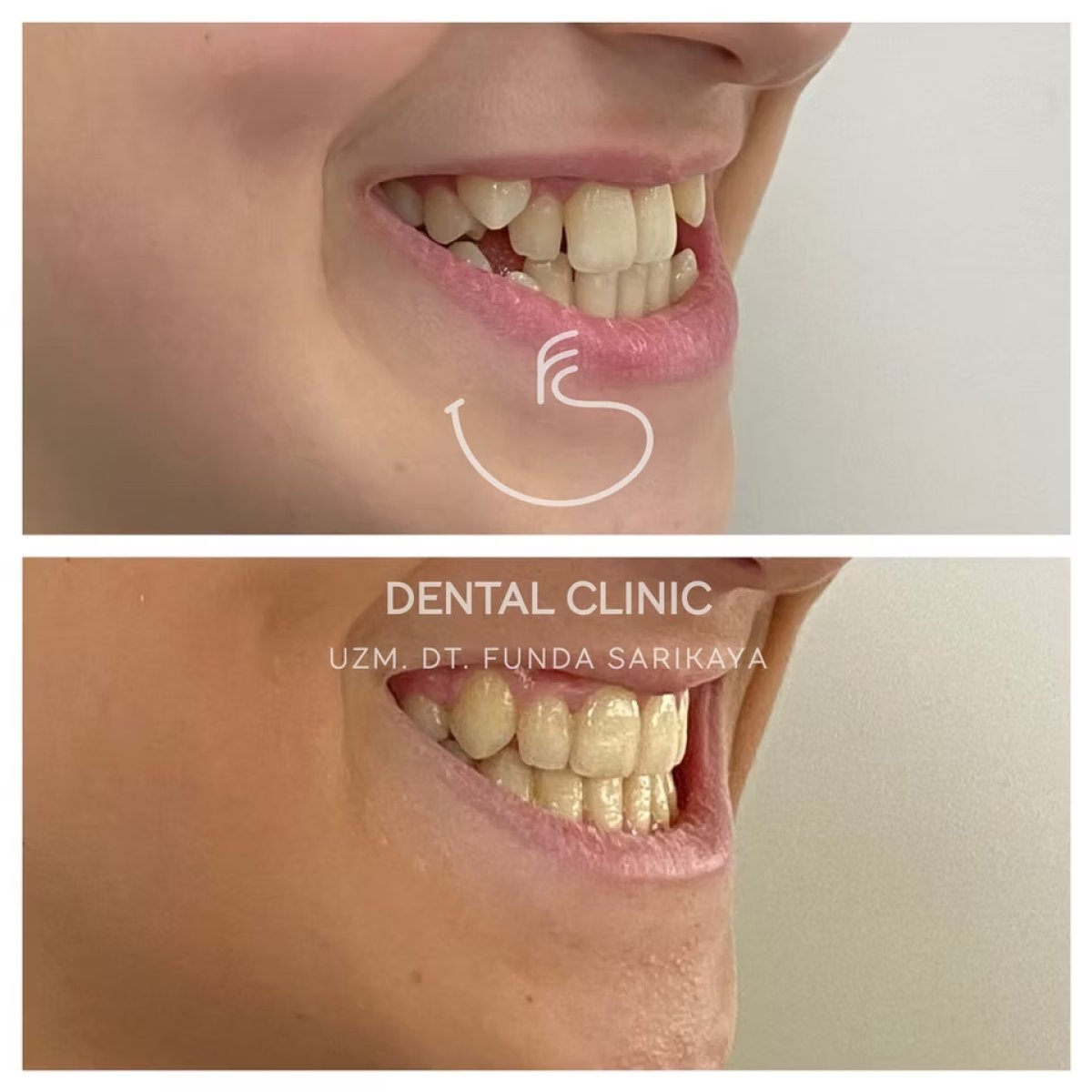 Resultados antes y después de empaste compuesto en Funda Sarıkaya Dental Clinic, sonrisa mejorada