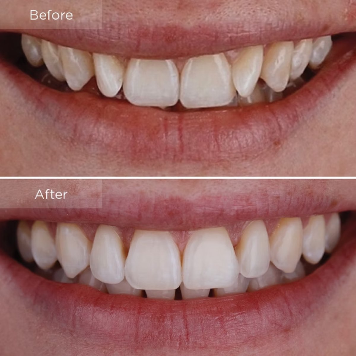Результаты отбеливания зубов до и после в Funda Sarıkaya Diş Polikliniği - Dental Clinic Ankara