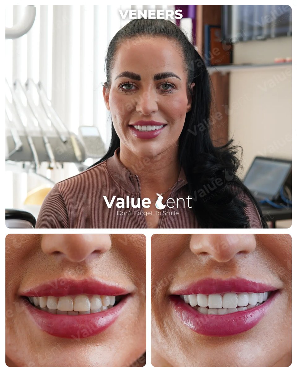 Avant et après facettes dentaires à la clinique Valuedent – sourire naturel transformé