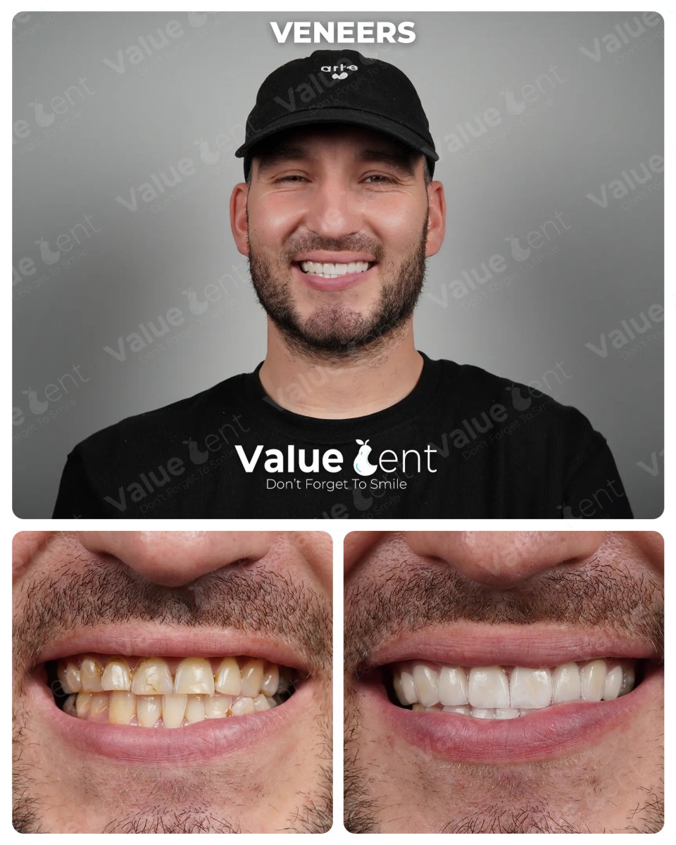 Avant et après facettes dentaires à la clinique Valuedent – sourire plus blanc et uniforme