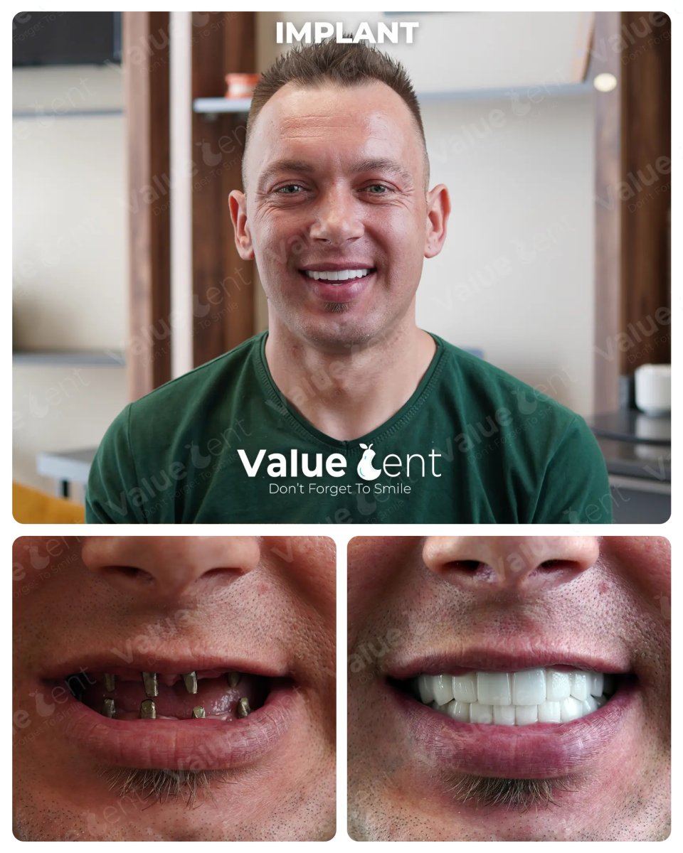 Before and after dental implant results at Valuedent Clinic – full smile restoration