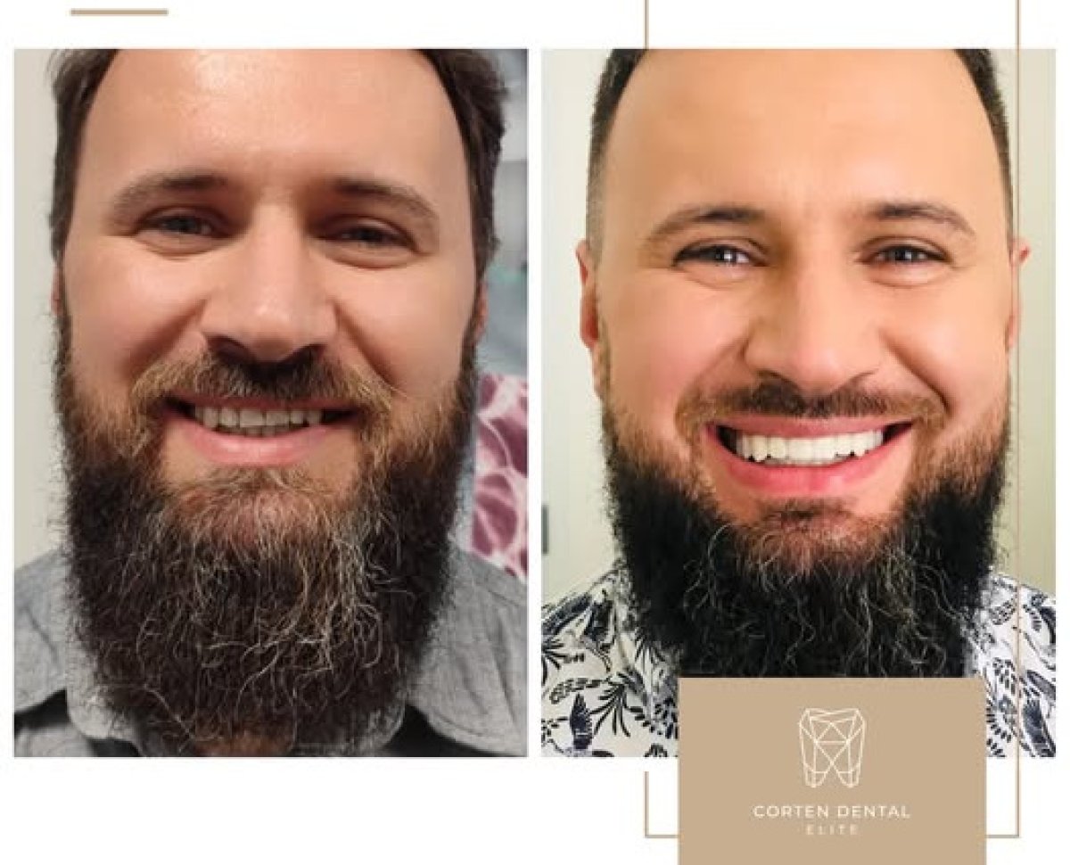 Результат до та після імплантації All-on-4 у Corten Dental Elite, покращена посмішка