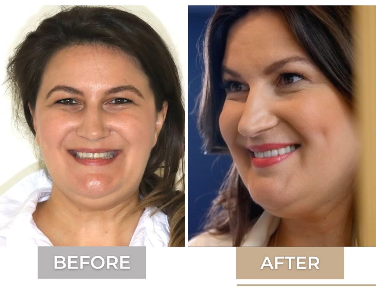 Результаты до и после Hollywood Smile в Corten Dental Elite, заметное преображение улыбки