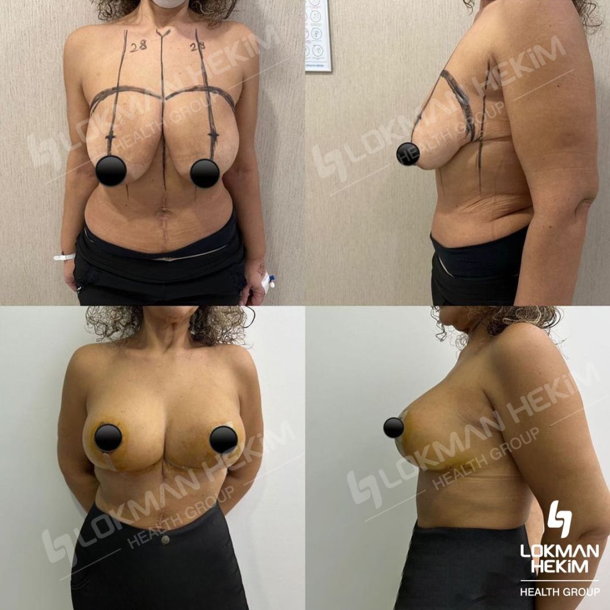 نتائج قبل وبعد عملية تجميل الأم في مستشفى لوكمان حكيم اسطنبول، تحسين شكل الجسم
