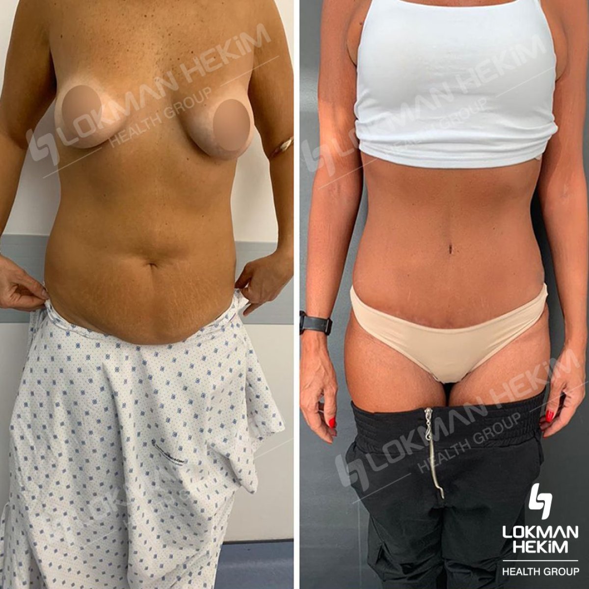 Before and after mommy makeover results at Lokman Hekim Istanbul Hospital, body contouring