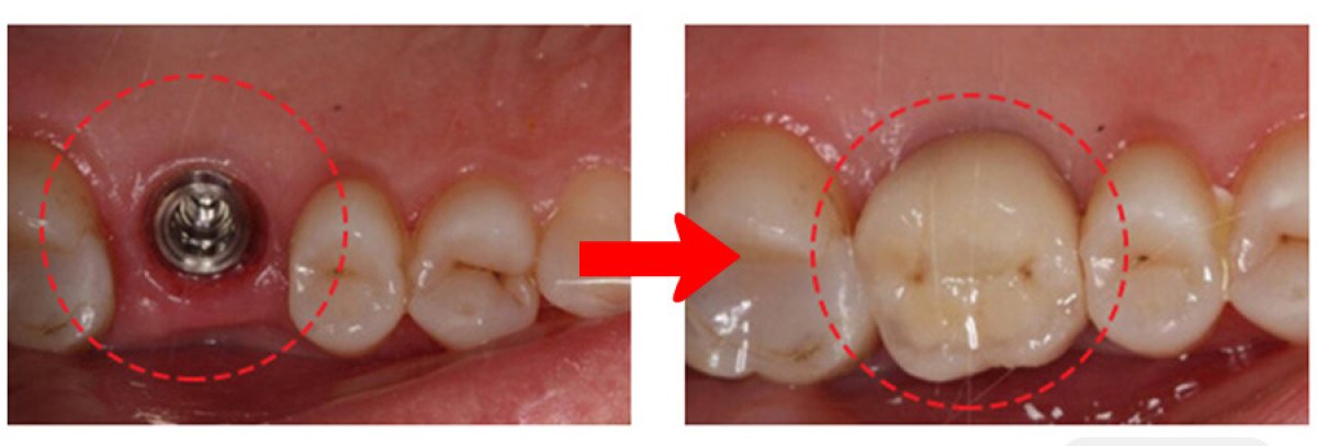 Before and after dental implant with crown result at SAIGON CENTER DENTAL CLINIC