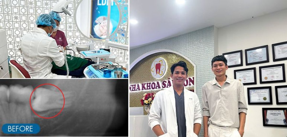 Результаты удаления зуба мудрости в SAIGON CENTER DENTAL CLINIC: рентген до и итог