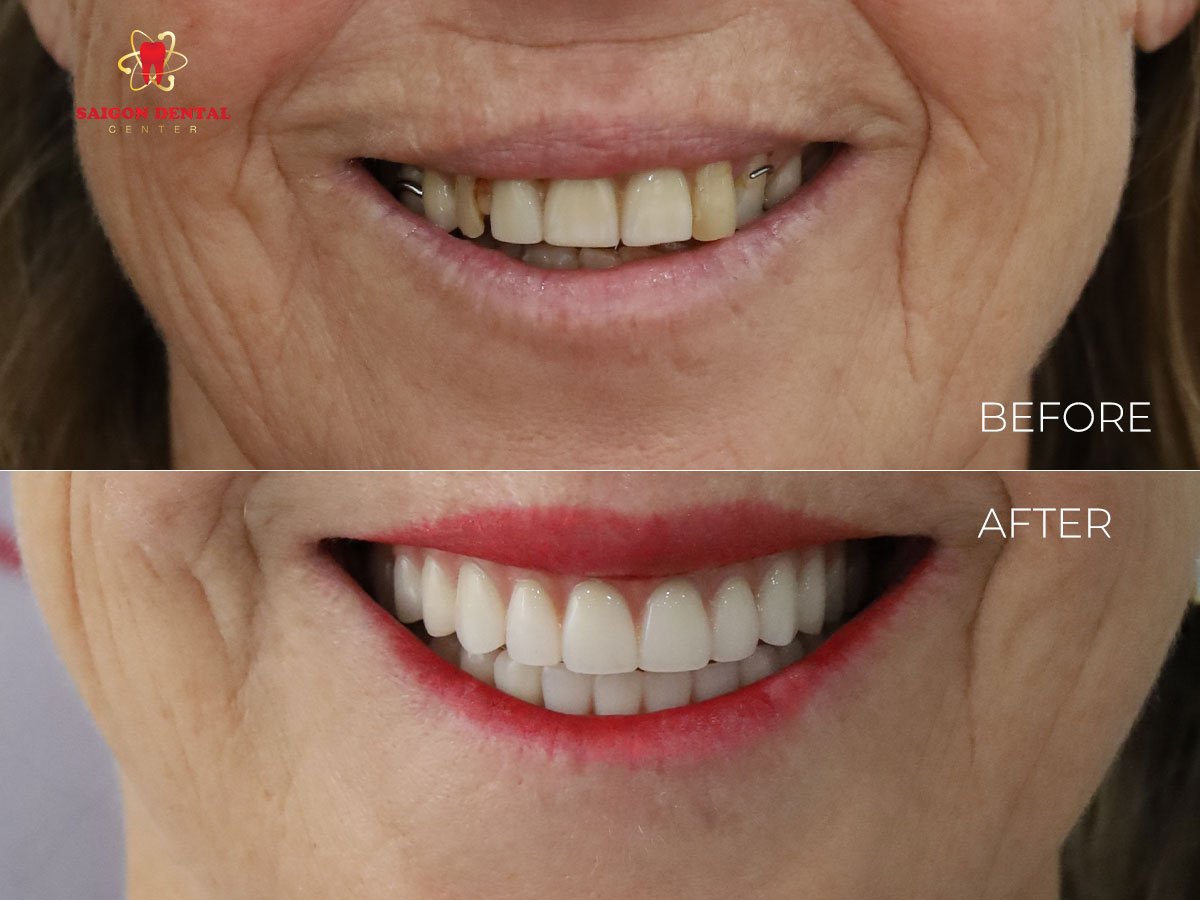 Resultados antes y después de implantes All-on-2 en SAIGON CENTER DENTAL CLINIC, sonrisa mejorada