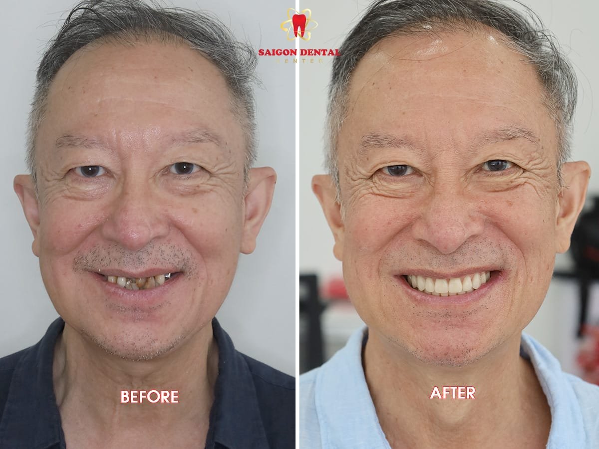 Resultados antes y después de implantes All-on-2 en SAIGON CENTER DENTAL CLINIC, sonrisa restaurada