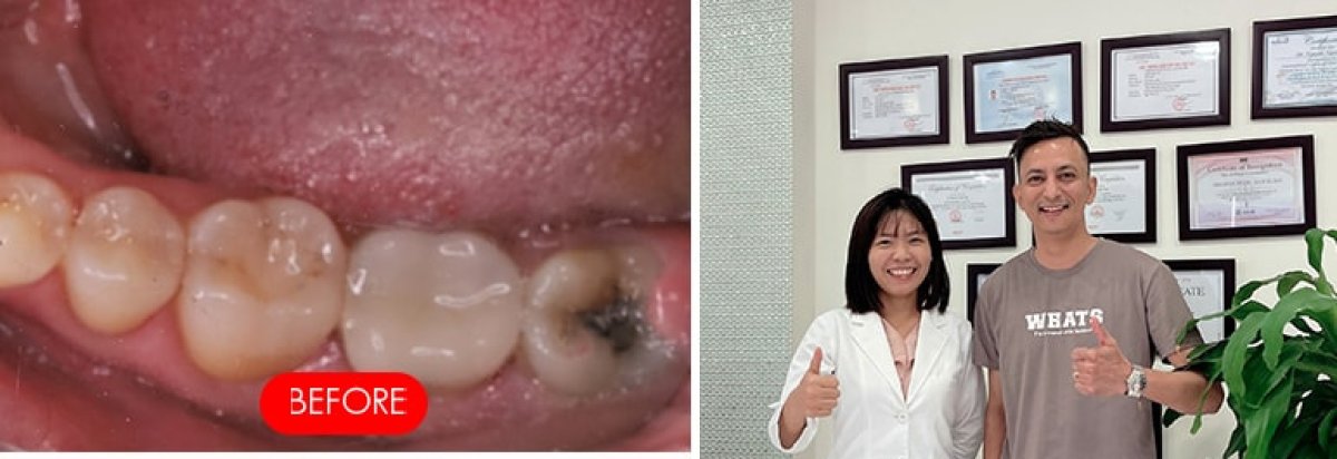 نتيجة تركيب تاج الأسنان في SAIGON CENTER DENTAL CLINIC، استعادة وظيفة السن