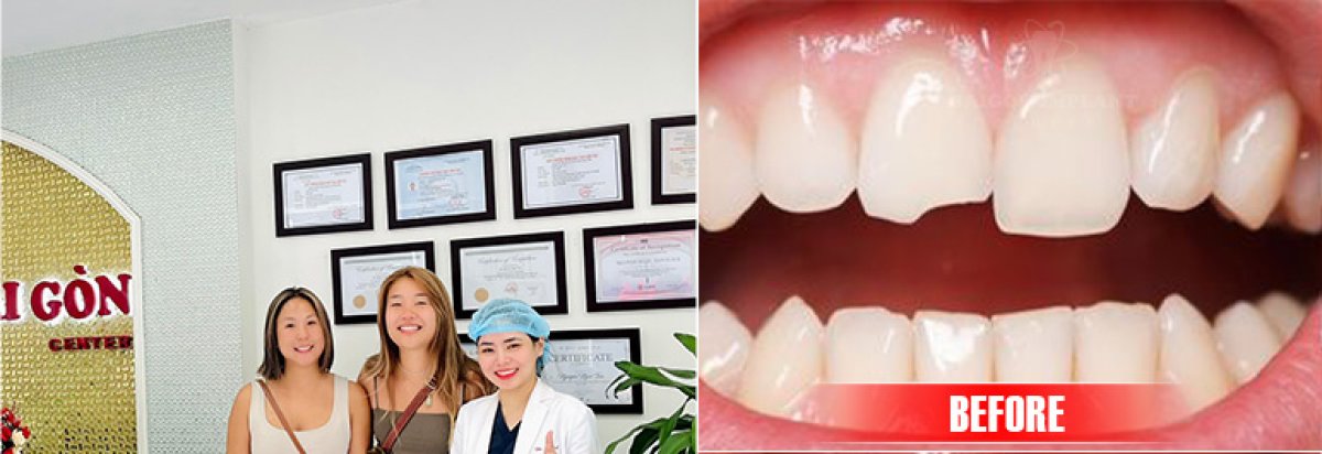 Résultat avant facettes composites à SAIGON CENTER DENTAL CLINIC, correction d'espace dentaire