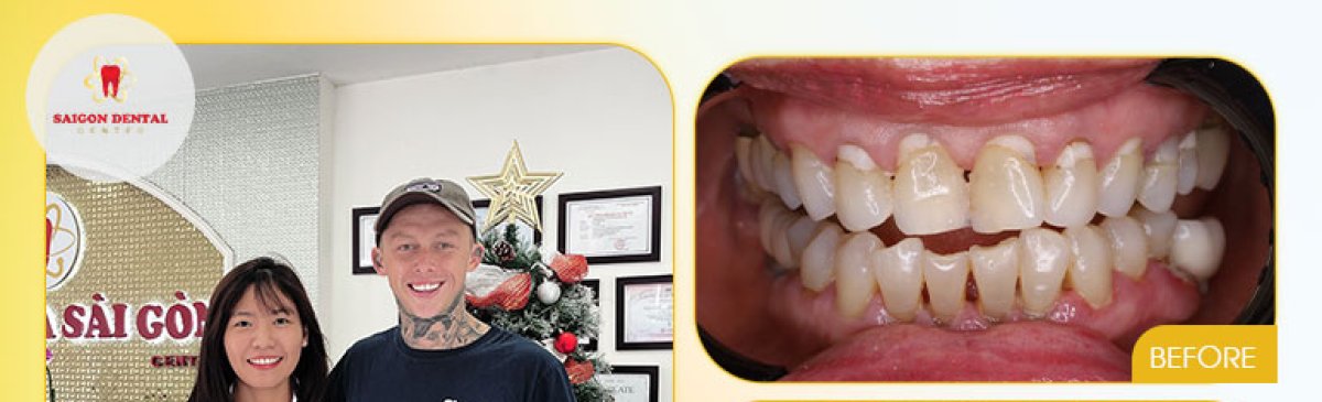 До установки виниров в SAIGON CENTER DENTAL CLINIC, видимые дефекты зубов результат