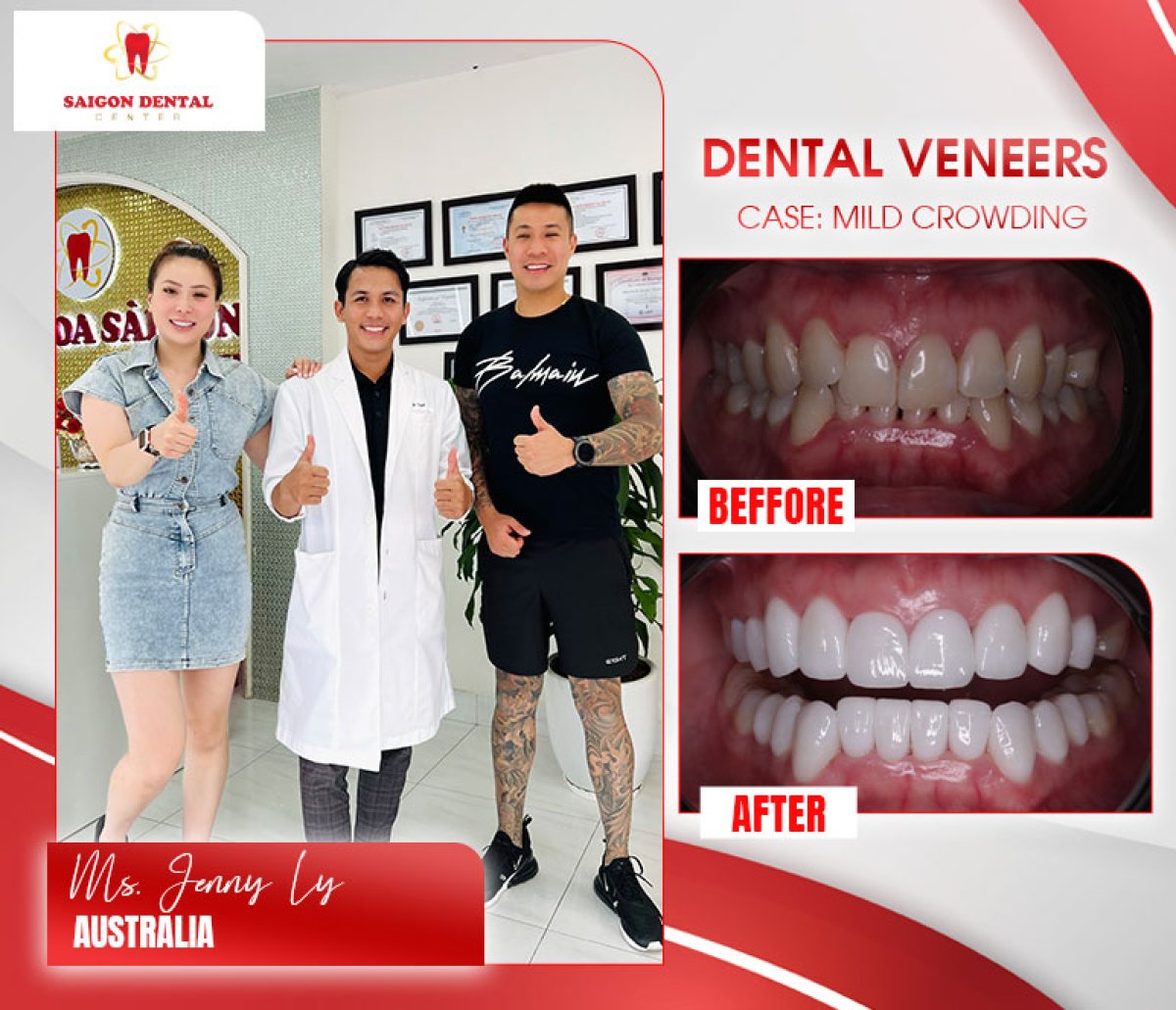 До и после установки виниров при легкой скученности в SAIGON CENTER DENTAL CLINIC, результат улыбки