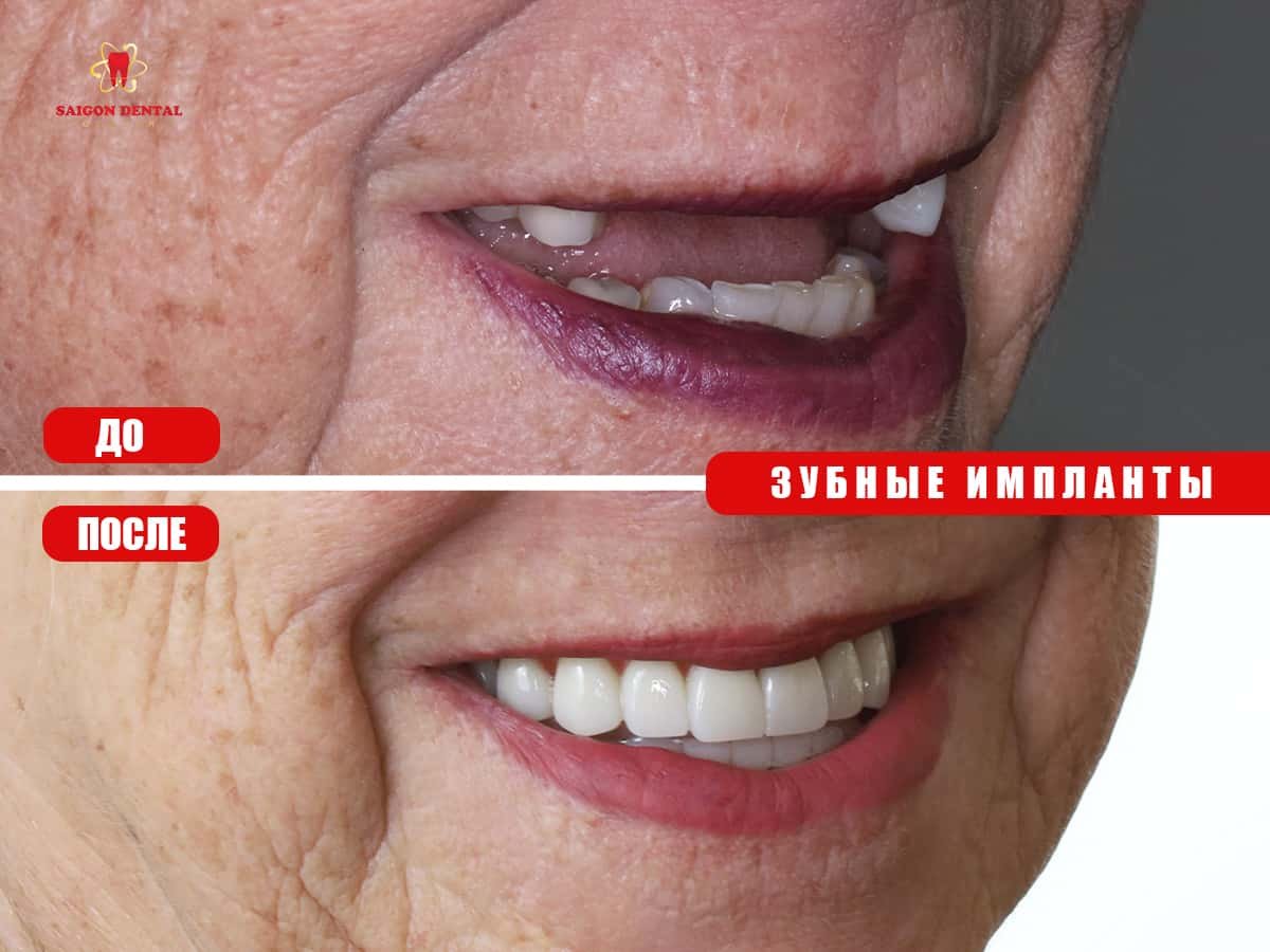 نتائج زراعة الأسنان قبل وبعد في SAIGON CENTER DENTAL CLINIC، ابتسامة محسنة