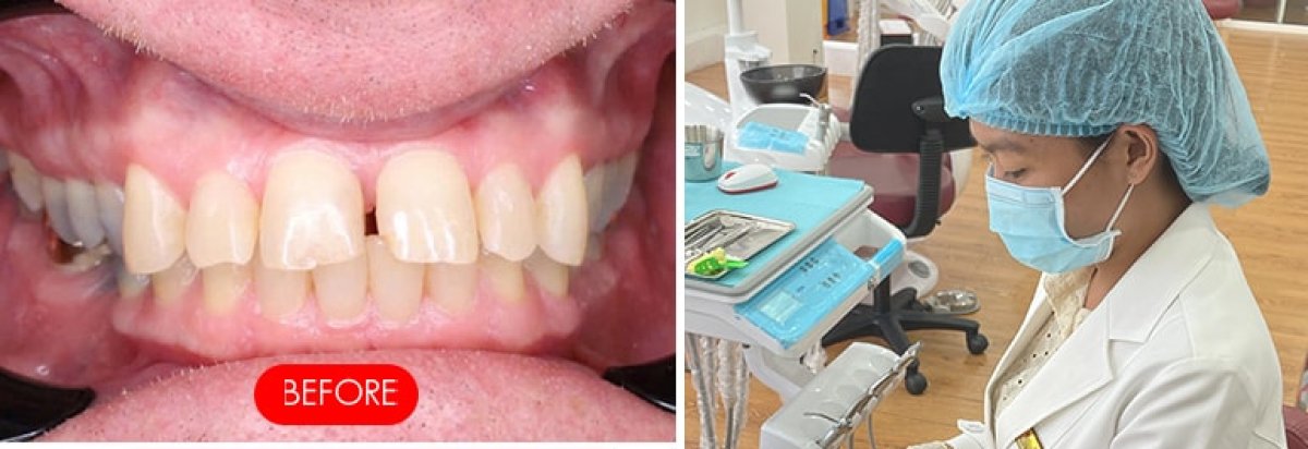 Установка фарфоровых коронок в SAIGON CENTER DENTAL CLINIC, результат до лечения
