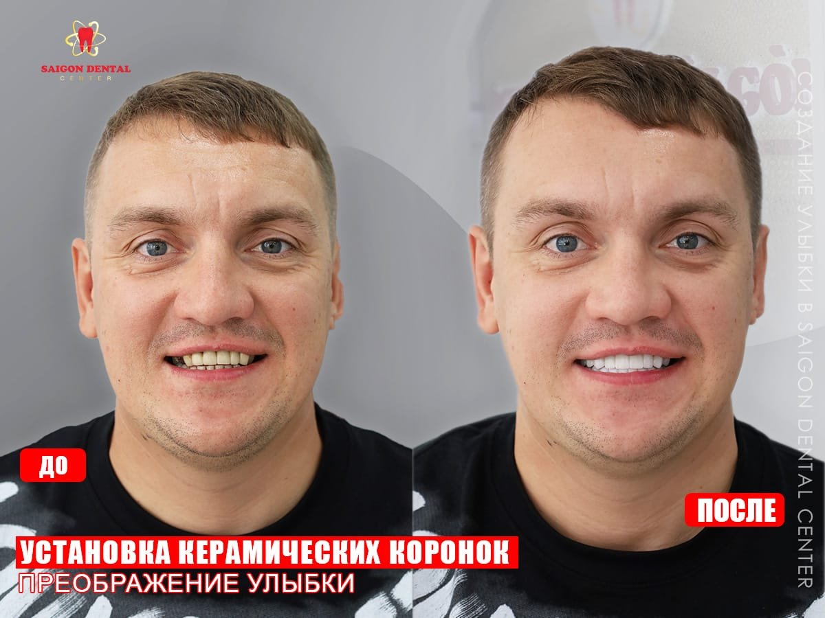 Результат до и после установки керамических коронок в SAIGON CENTER DENTAL CLINIC, улыбка