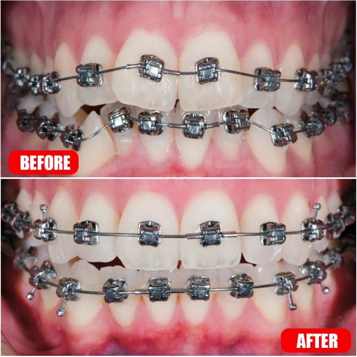 Результаты до и после брекетов в SAIGON CENTER DENTAL CLINIC, улучшение выравнивания зубов