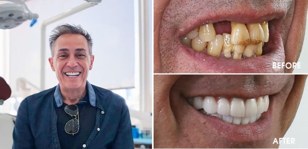 Before and after denture results at SAIGON CENTER DENTAL CLINIC – restored bright smile