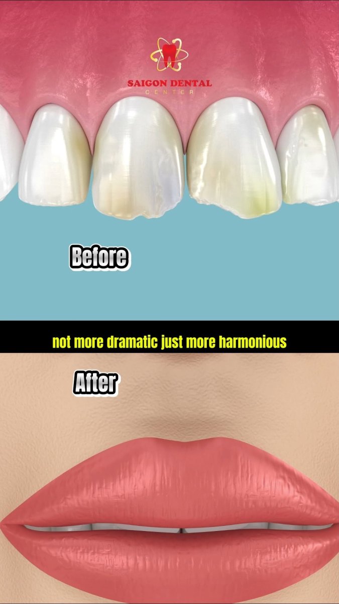 Результаты до и после улыбки в SAIGON CENTER DENTAL CLINIC, естественная гармония