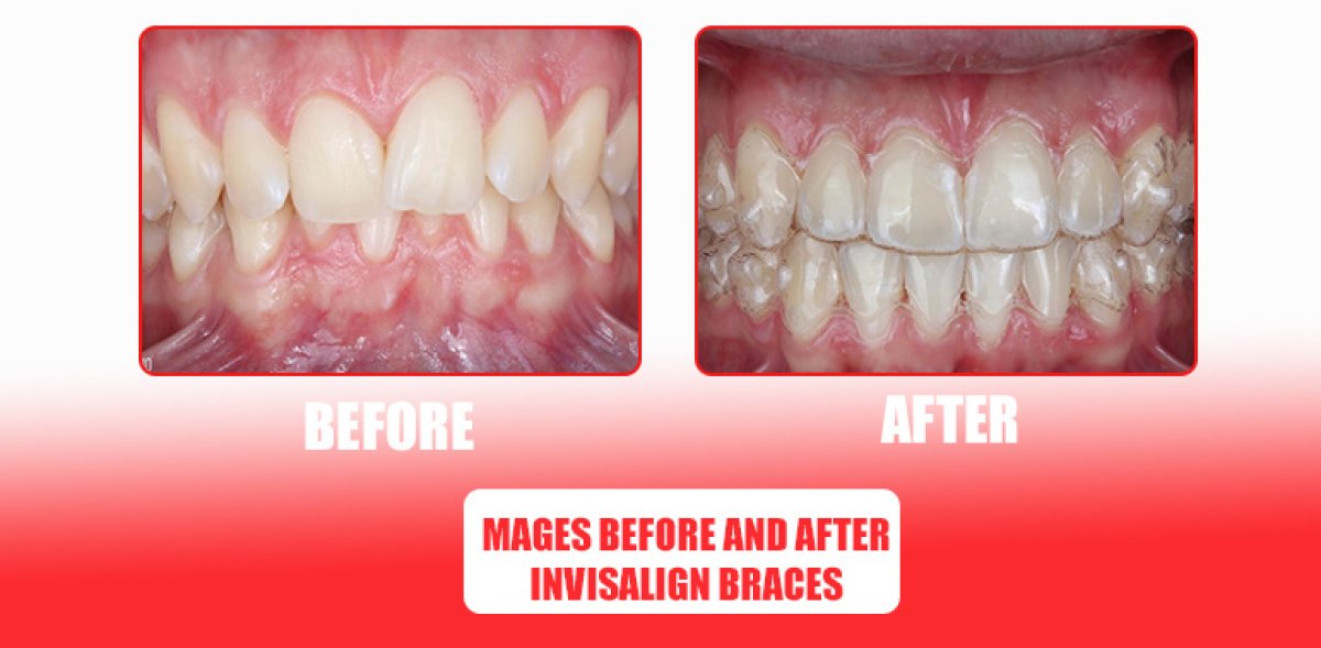 نتائج قبل وبعد التقويم الشفاف في SAIGON CENTER DENTAL CLINIC، تحسين انتظام الأسنان