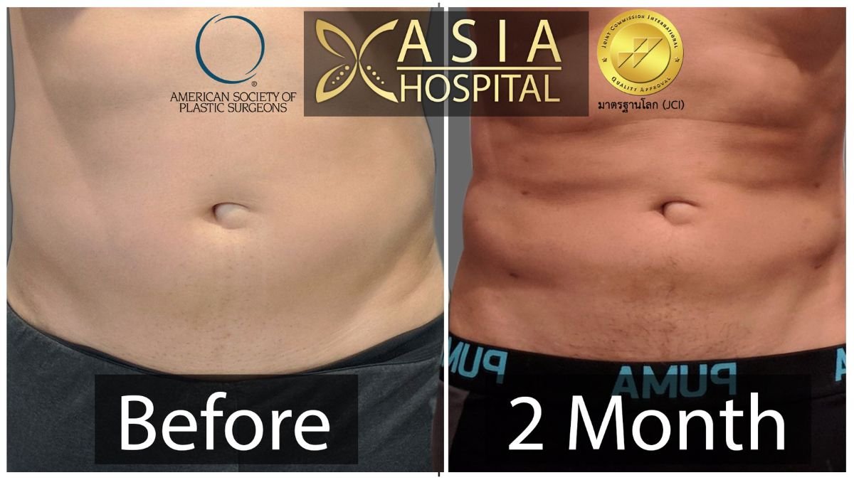 Результати Vaser ліпосакції до і після в Asia Cosmetic Hospital, покращений контур живота