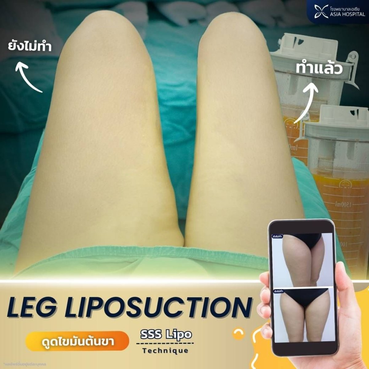 Before and after leg liposuction results at Asia Cosmetic Hospital, thigh contour improvement