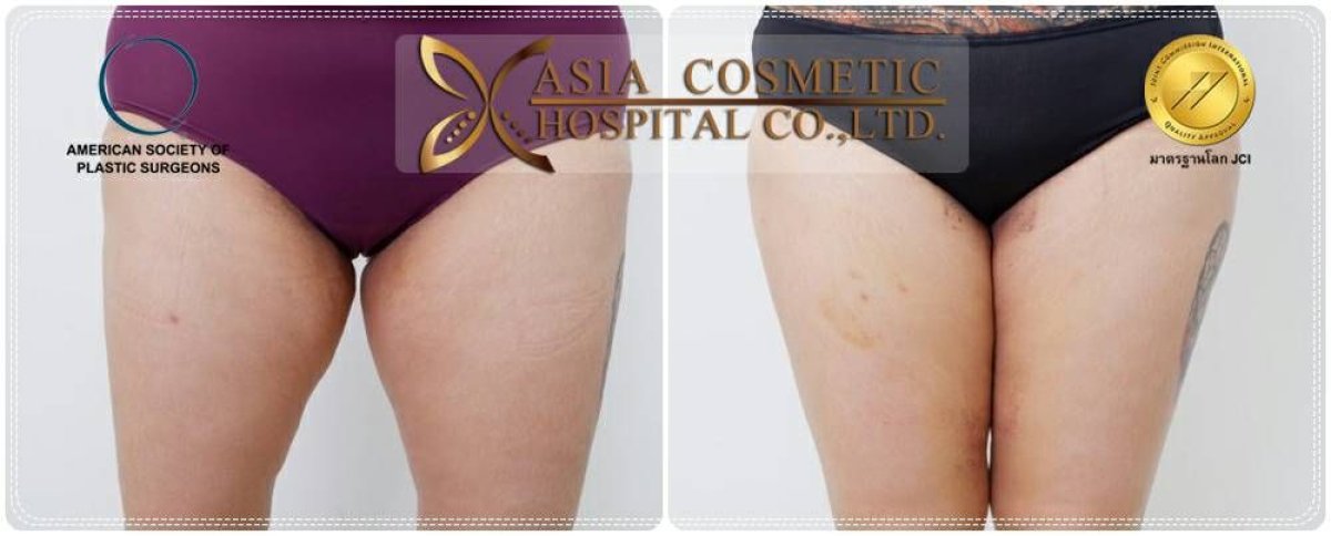 Before and after full body lift results at Asia Cosmetic Hospital, improved thigh contour visible