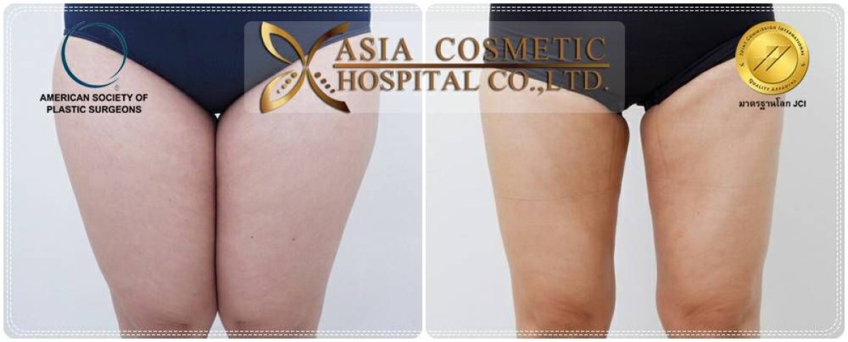 Before and after full body lift results at Asia Cosmetic Hospital, improved thigh contour