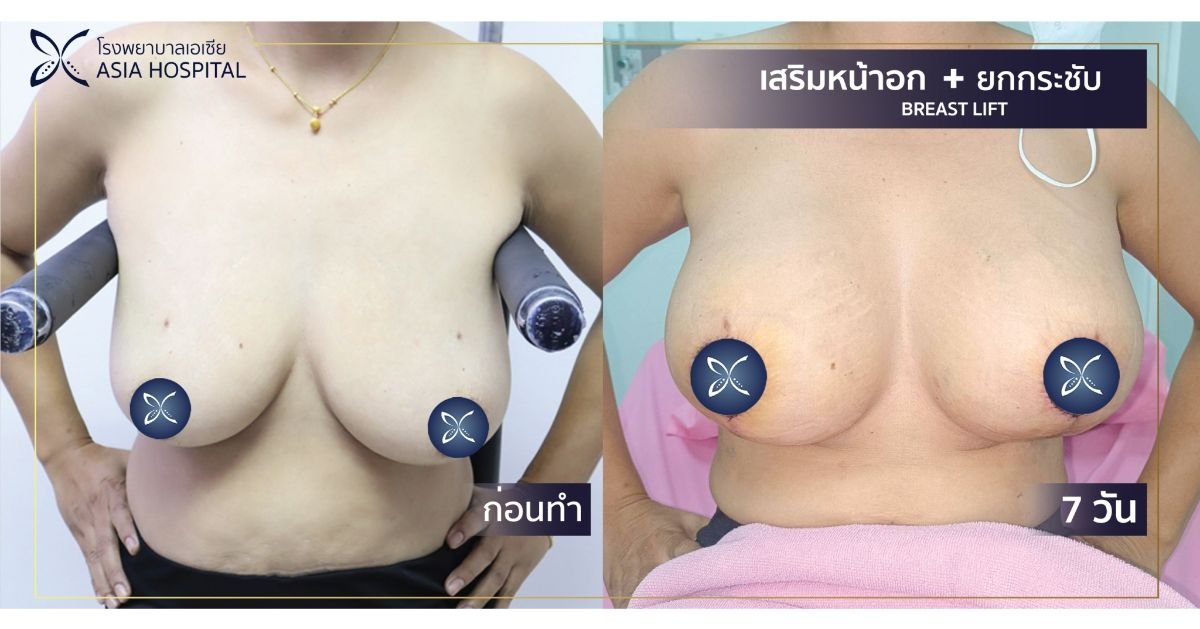 Before and after breast lift results at Asia Cosmetic Hospital, improved breast contour visible