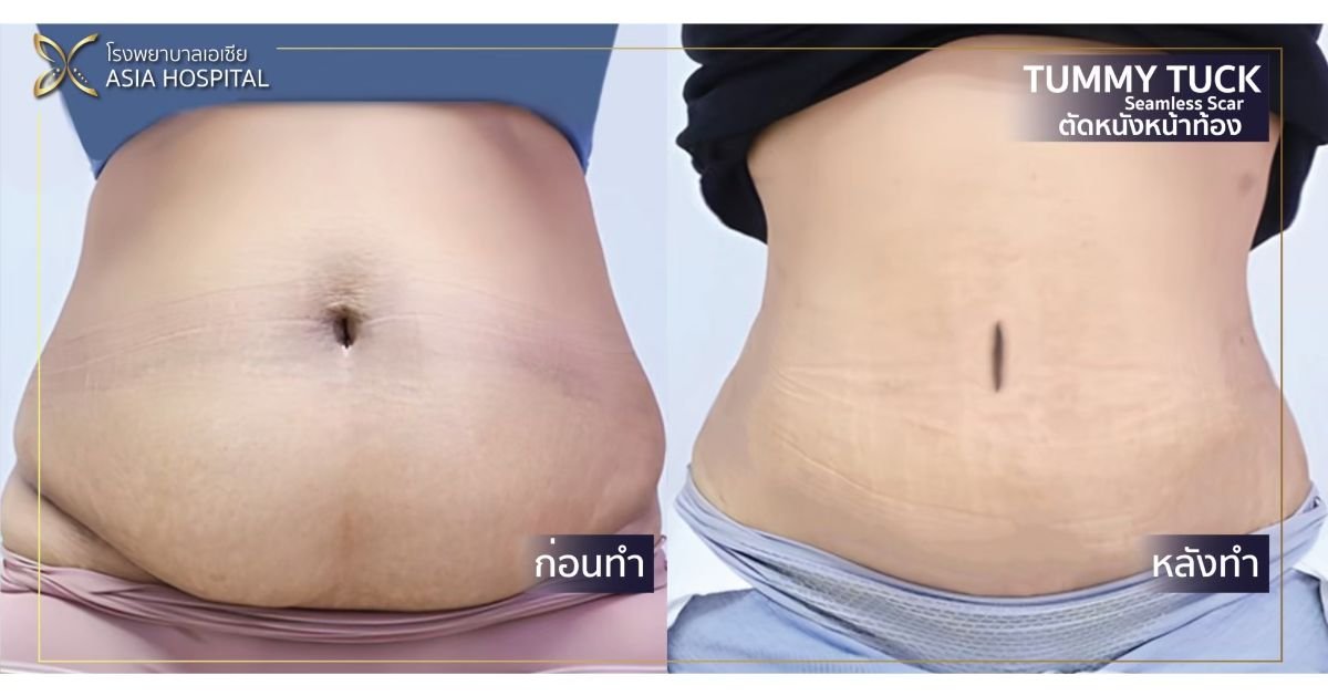 Before and after tummy tuck results at Asia Cosmetic Hospital – flatter, firmer abdomen