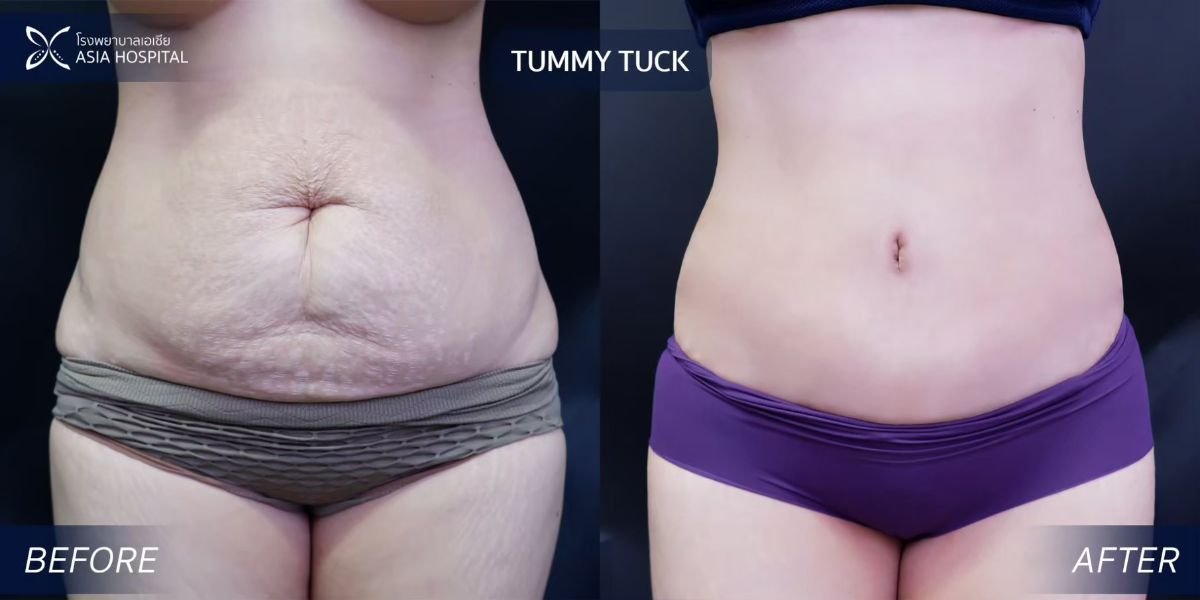 Before and after tummy tuck results at Asia Cosmetic Hospital – flatter, firmer abdomen