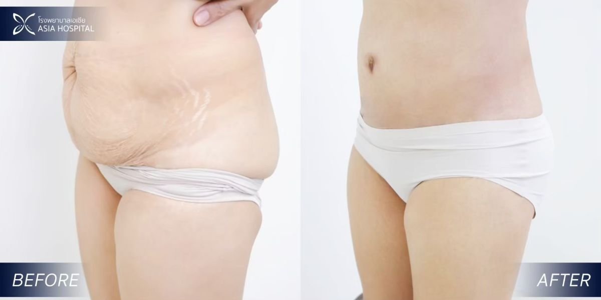Full body lift before and after result at Asia Cosmetic Hospital, improved abdominal contour