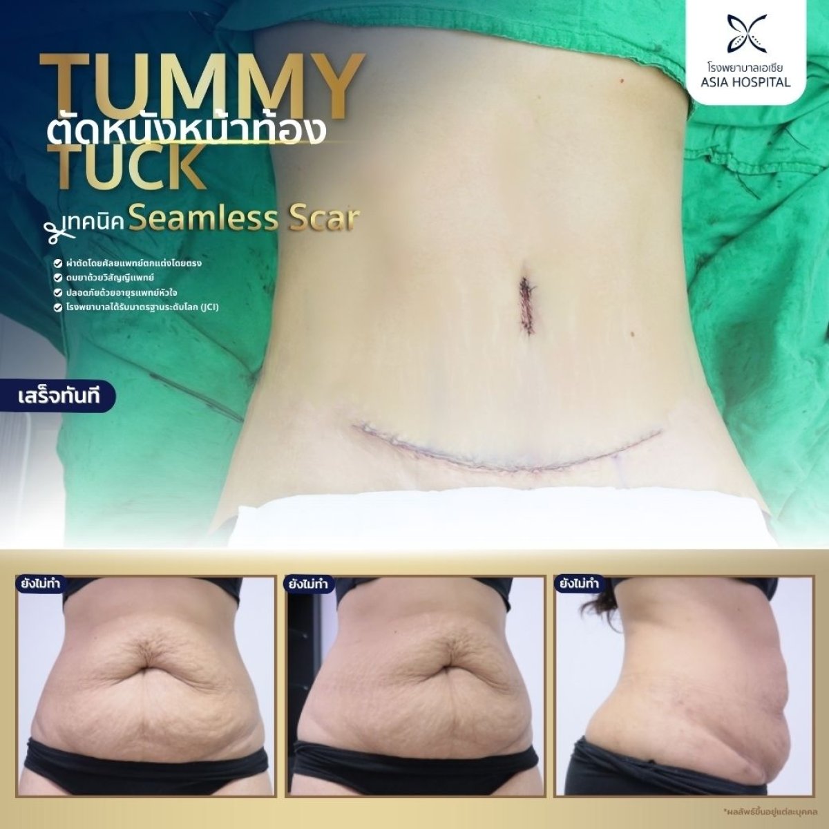 Before and after tummy tuck results at Asia Cosmetic Hospital, seamless scar body lift outcome