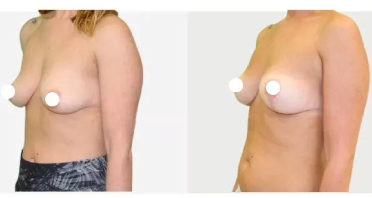 Before and after breast lift results at Premier Clinic, improved breast shape and contour