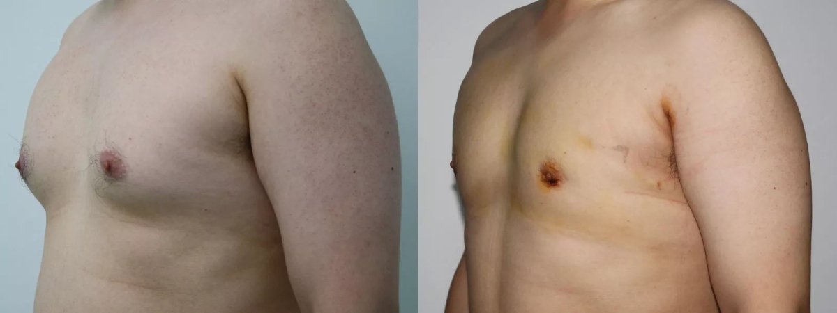 Resultados de liposucción antes y después en Premier Clinic, mejor contorno torácico masculino