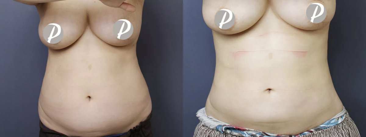 Before and after tumescent liposuction results at Premier Clinic, abdomen contour improvement
