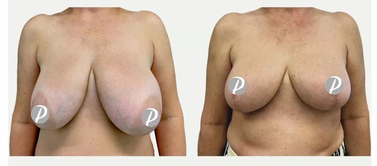 نتائج تصغير الثدي قبل وبعد في Premier Clinic، تحسين شكل ورفع الثدي