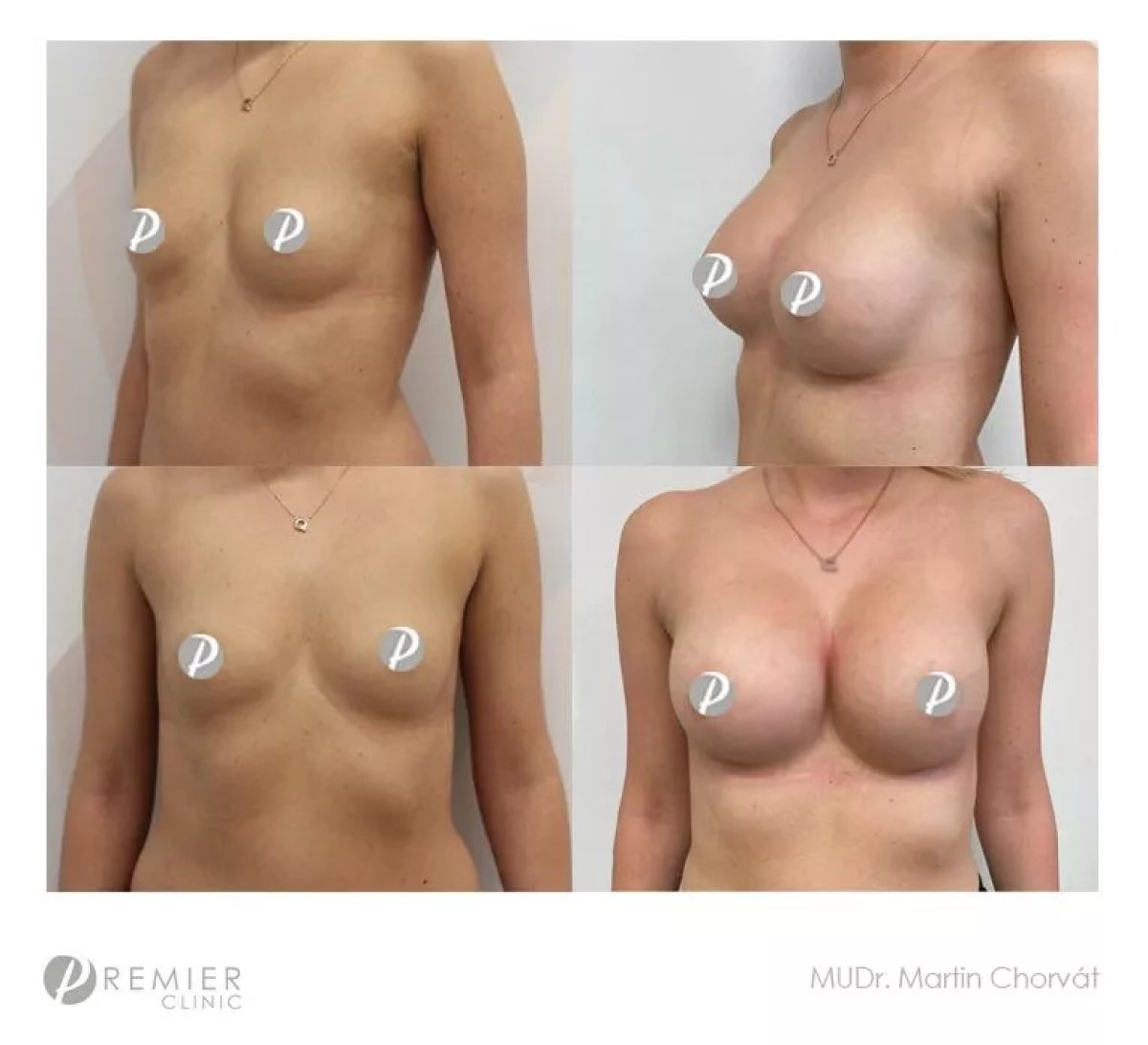 Before and after breast augmentation results at Premier Clinic, enhanced breast shape and size